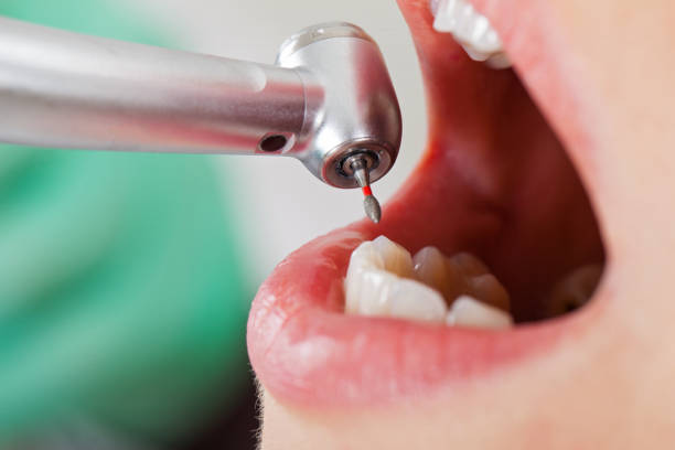 Best Emergency Wisdom Teeth Removal in Harrison, NY
